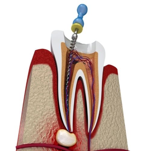 Root Canal Treatment near me - Hashtag Smile Health