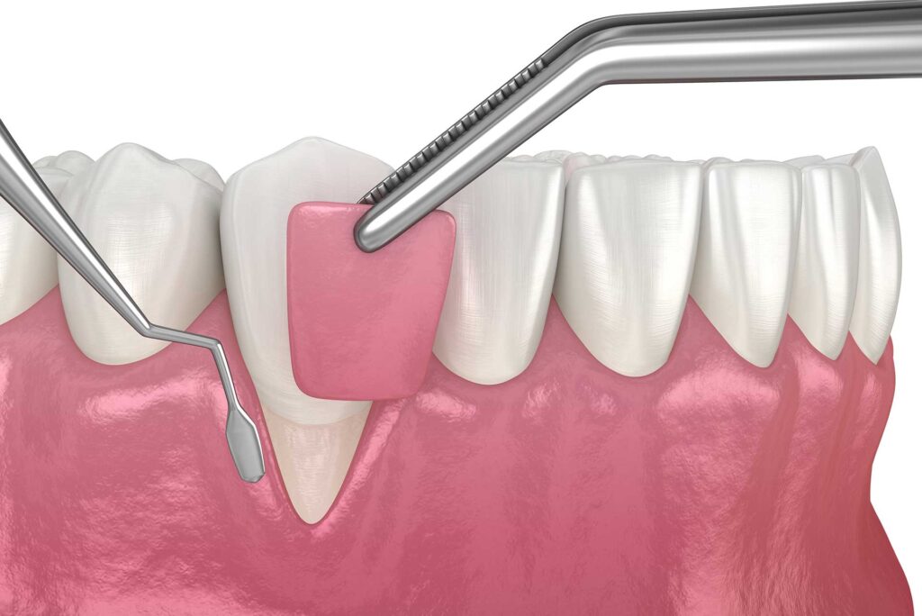 gum grafts