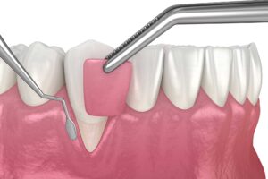 gum grafts
