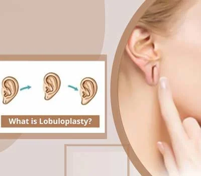 Specialized Lobuloplasty treatments near me - Hashtag Smile Health