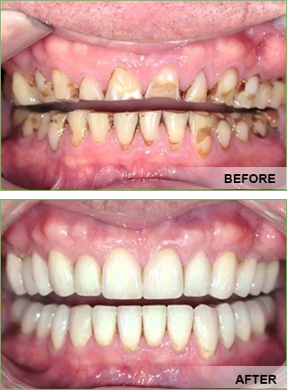 Full-Mouth-Reconstruction - services near me - hashtag smile health