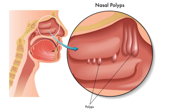 Nasal Polyp - ENT in Kannamangala