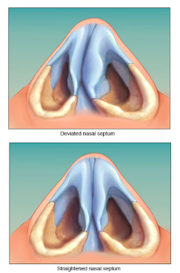 Nasal Treatment - ENT in Kannamangala