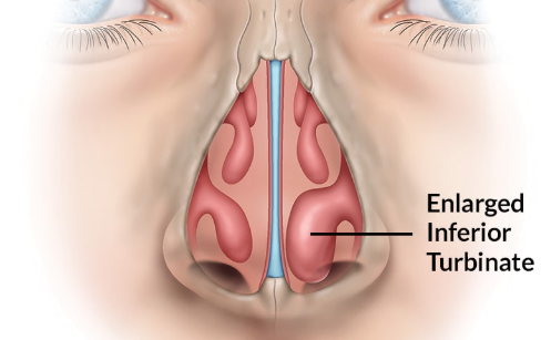 Nose - ENT in Kannamangala