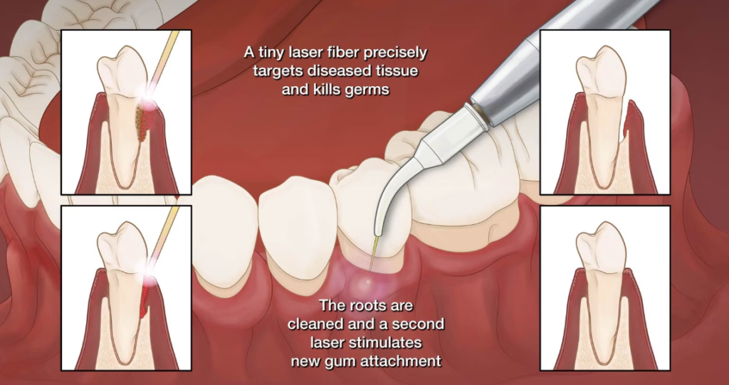 LANAP for Gum Disease