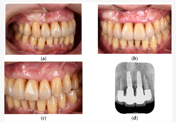 Dental Implant