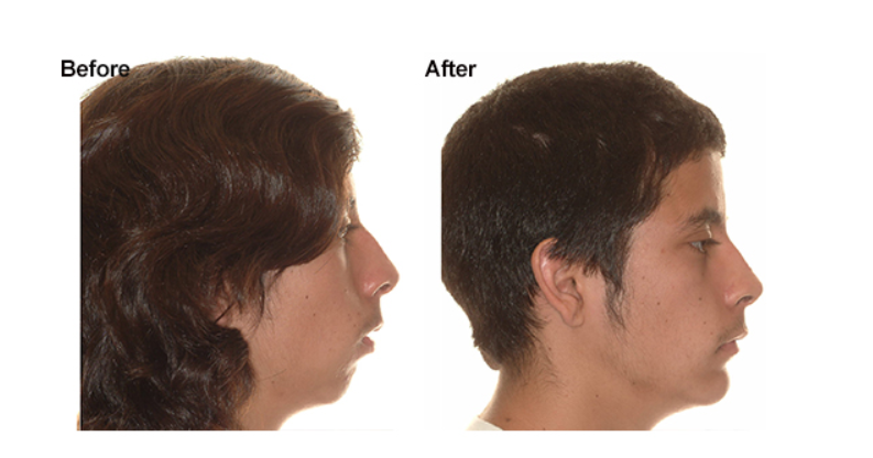 Ortho braces and facial changes