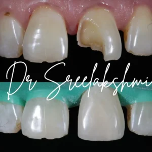 Composite Restoration