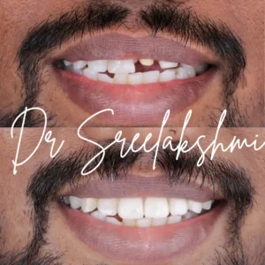 Emax Veneers & Crowns