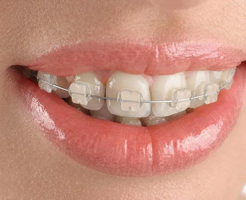 cermaic braces in bangalore