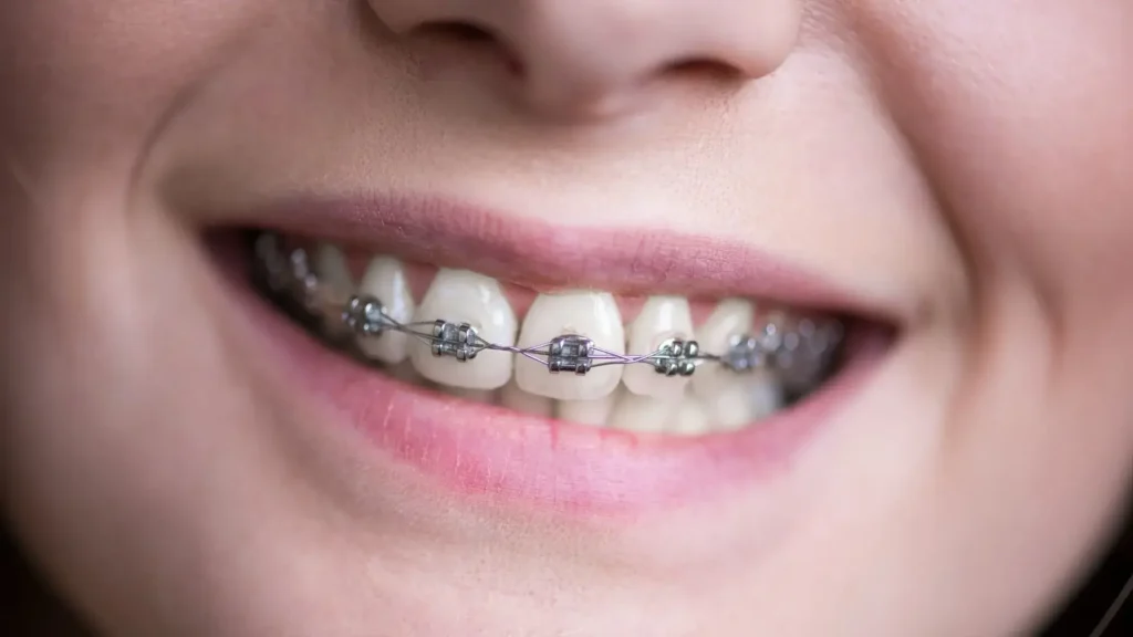 dental braces in bangalore