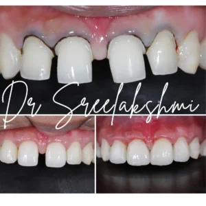 digital smile design bangalore
