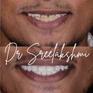 digital smile design bengaluru