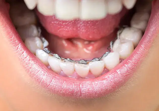 lingual braces bangalore