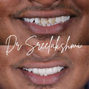 Emax Veneers