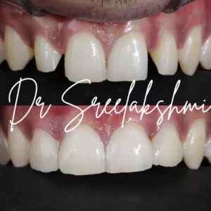 smile makeover in bangalore
