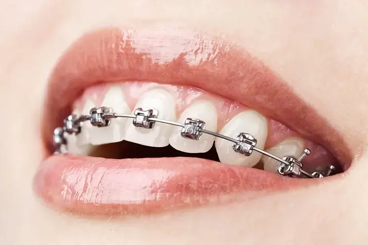 Damon Metal teeth braces bangalore