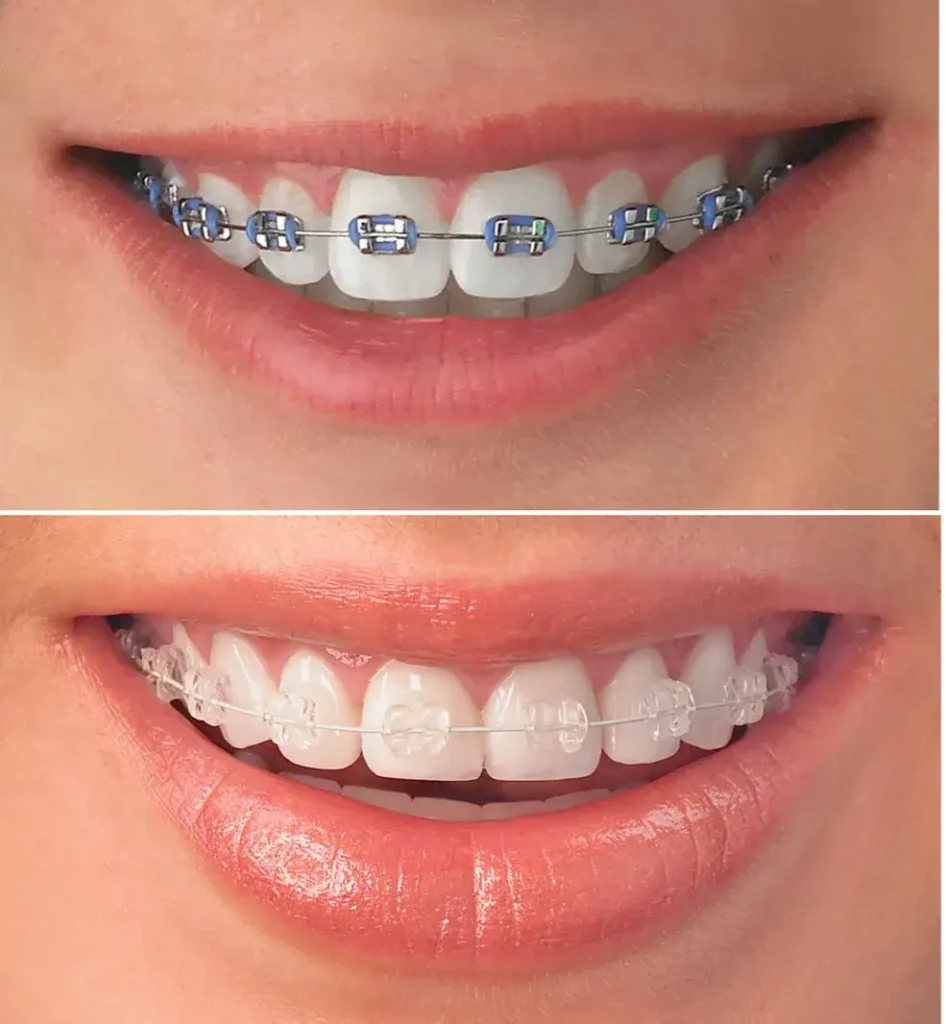 teeth braces in bangalore