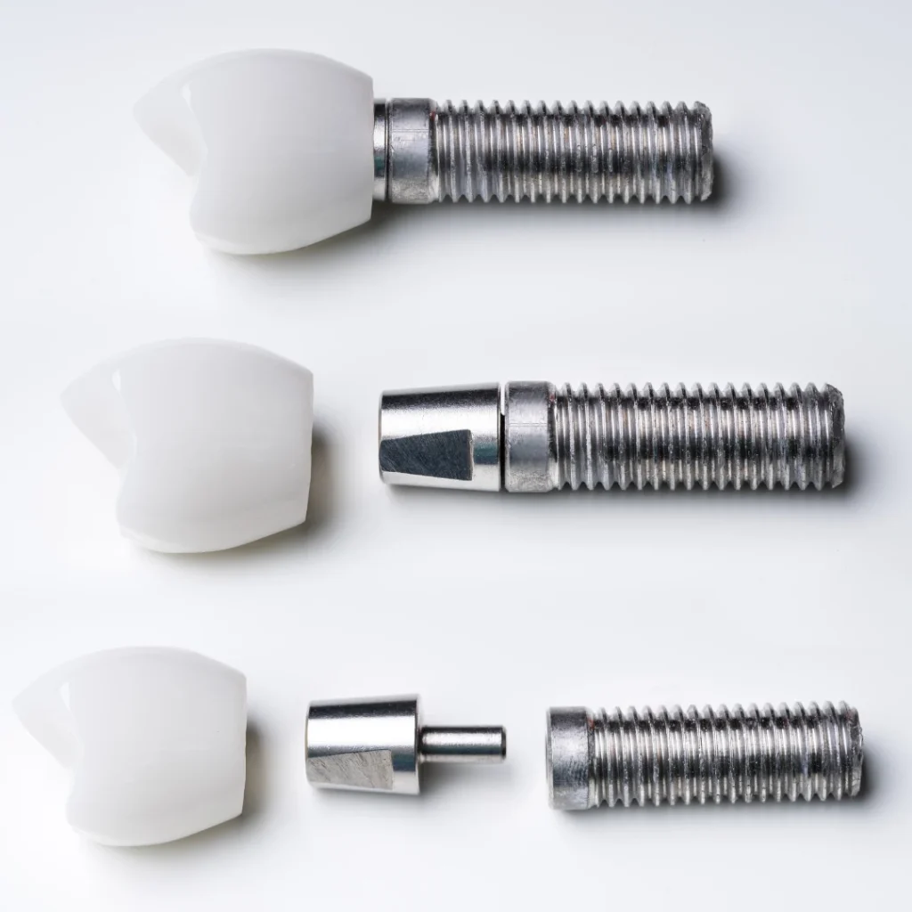 dental implants bangalore