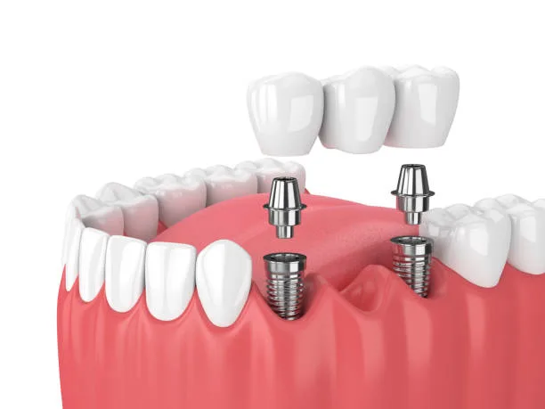 dental implants in bengaluru