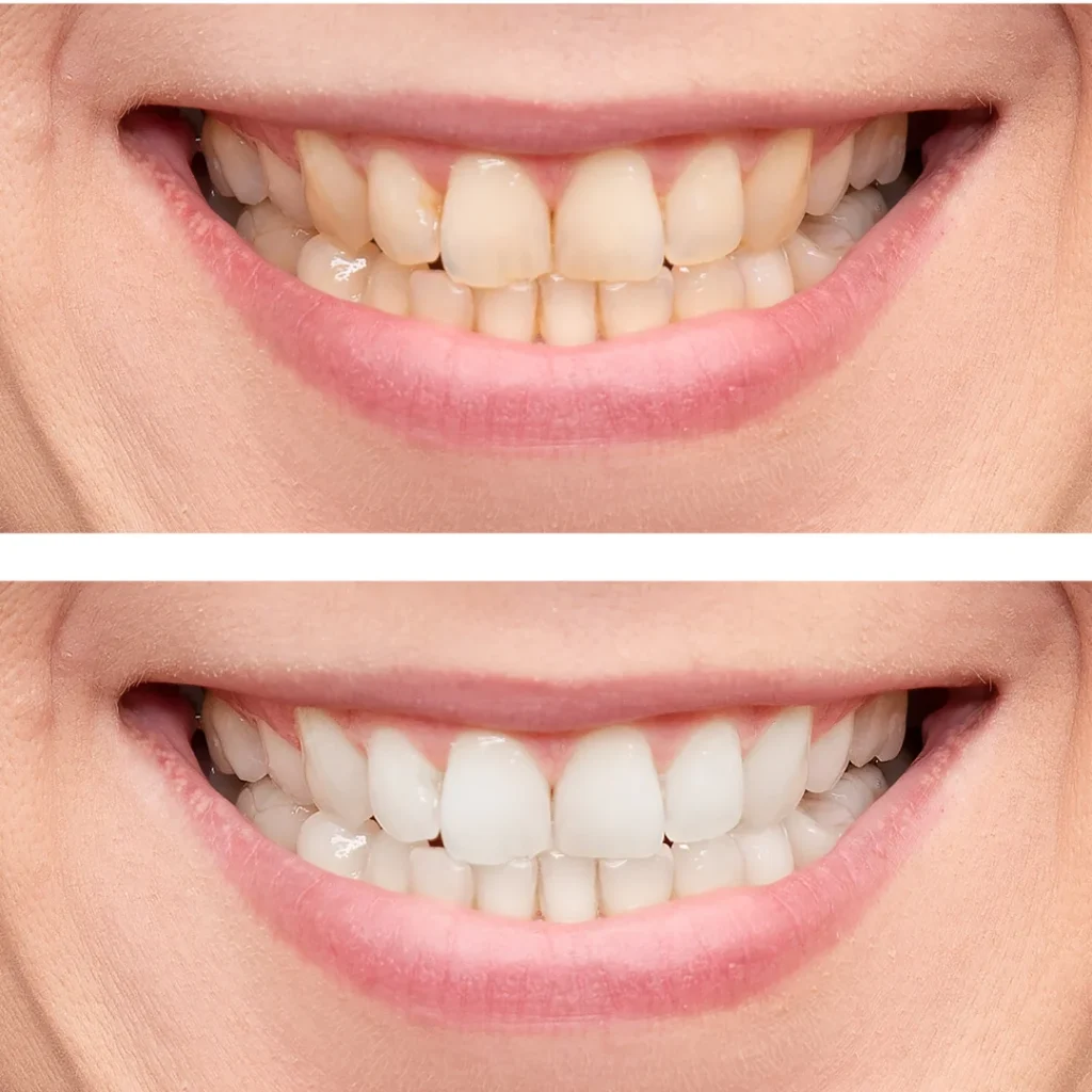 expert teeth whitening in bangalore