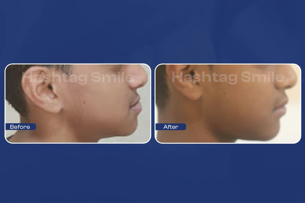 fix jaw without surgery