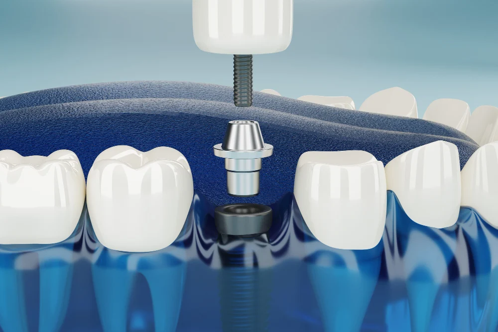 guide to dental implants what are dental implants