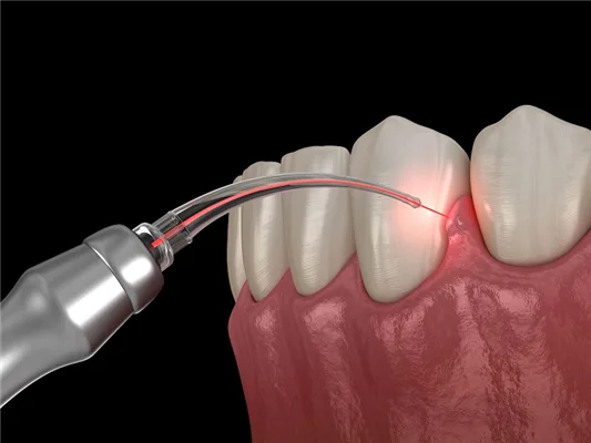 laser dentistry in bangalore