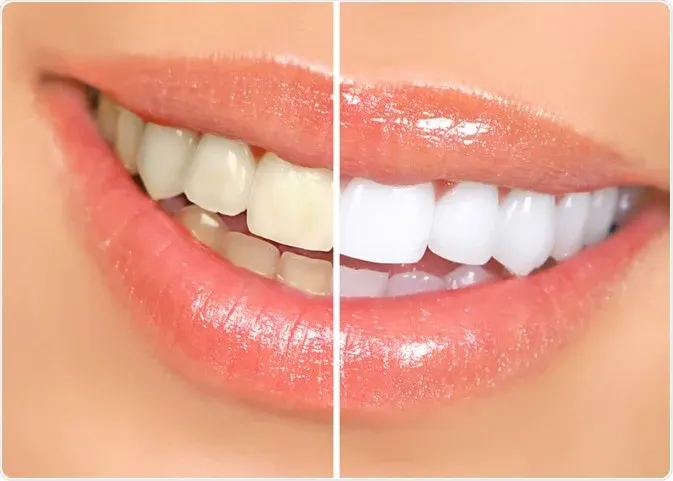 professional teeth whitening in bangalore