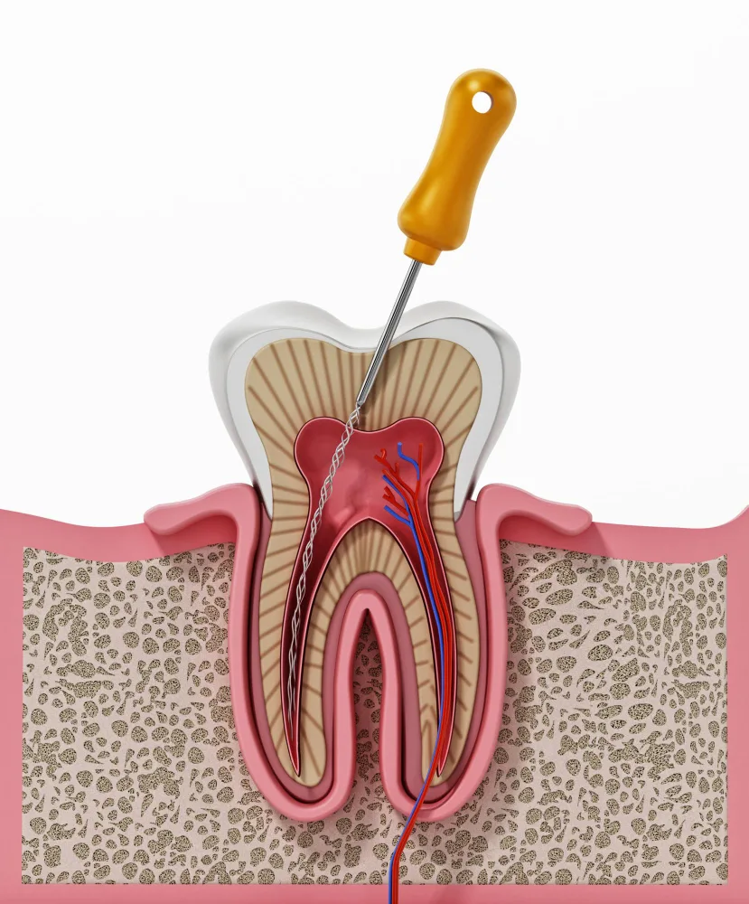root canal treatment dental clinic bangalore