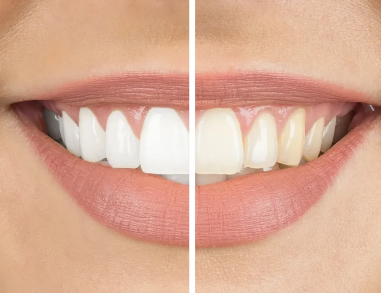 teeth whitening treatment in bengaluru