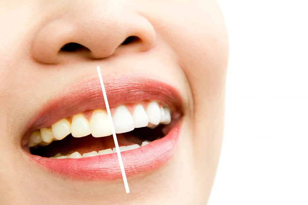 teeth whitening in bengaluru