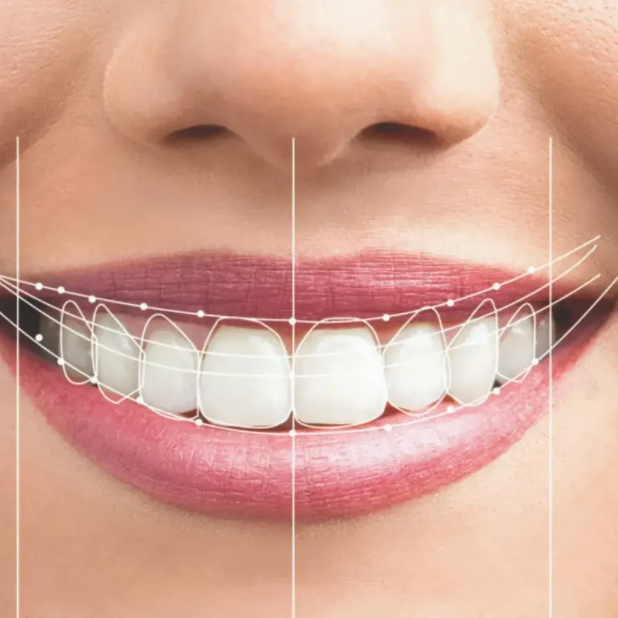 smile correction in bangalore smile correction in bangalore